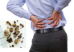 Đau vùng chậu là biểu hiện của sỏi thận 3mm